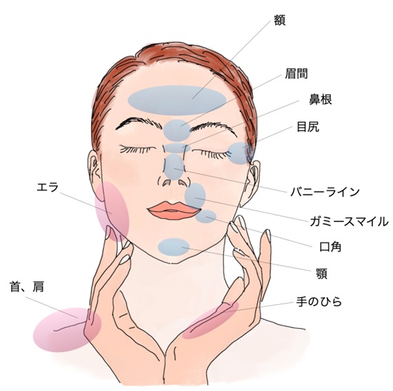しわのボトックス治療