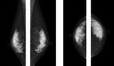 マンモグラフィ（乳房撮影）