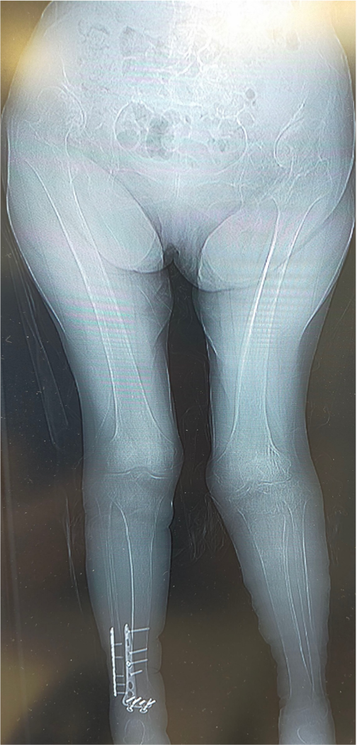 術前の歩行の様子